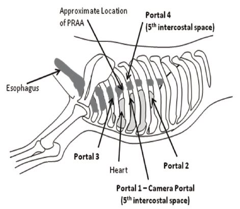 Approximate location of the 4 thoracoscopic portals used for ligation ...