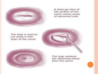 Loop Electrosurgical Excision Procedure PPT