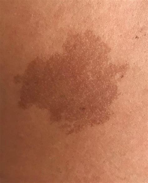 Birthmarks Zenith Cosmetic Clinics