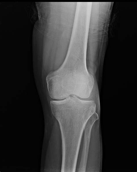 Pre Patellar Bursitis Image Radiopaedia Org