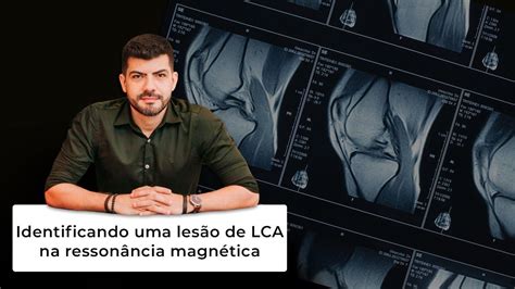 Como identificar uma lesão de LCA na ressonância magnética YouTube