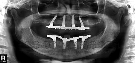 Técnica All on four e a realização de implantes osseointegrados sem