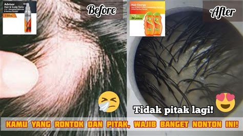 Cara Mengatasi Rambut Rontok Ketombe Pitak Shampoo Hair Tonic