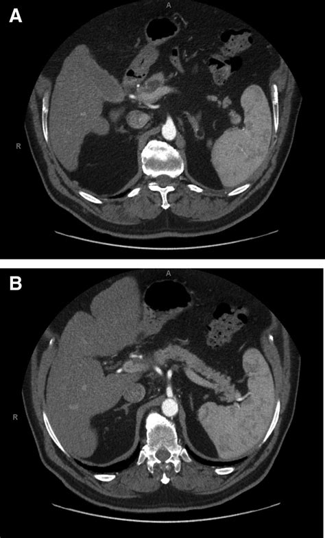 An Unexpected Etiology Of Pancreatic Panniculitis A Case Report Journal Of Pancreatic Cancer