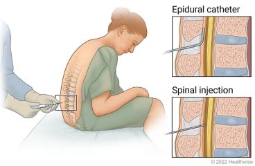 Spinal And Epidural Anesthesia Cigna