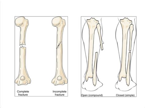 Complete Vs Incomplete Fracture