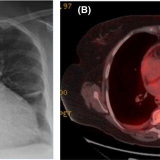 A Chest Xray Showing Cardiomegaly B Moderate Uptake In The Pleura