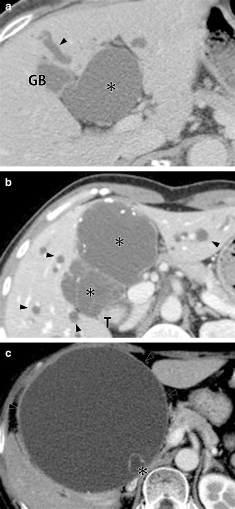 Differences Between Large Peribiliary Cysts And Cystic Biliary Tumors