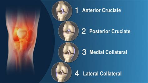 Medial Collateral Ligament Knee Pain