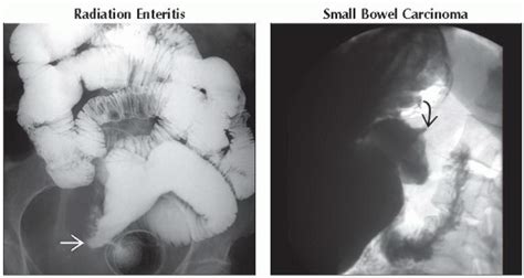 Da Db Small Bowel Obstruction Ffu Abdominal Key