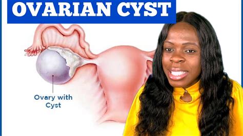 What Is Ovarian Cystwhat Are The Types Of Ovarian Cystdoes Ovarian Cyst Affect Getting