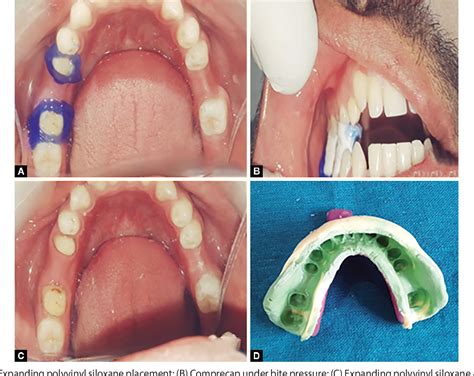 Figure 3 From Evaluation Of Effectiveness Of Three New Gingival