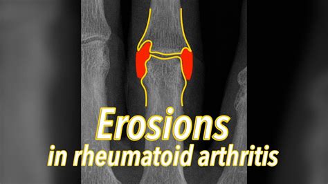 Erosions On X Rays In Rheumatoid Arthritis Explained In Seconds