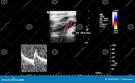 Pulse Wave Doppler Ultrasound Examination. Stock Image - Image of flow ...