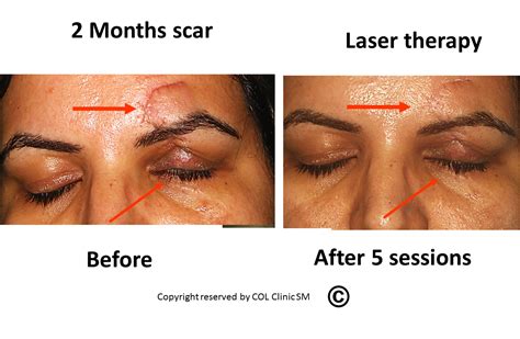 Photo Gallery Scar And Keloid Revision Canadian Optic And Laser Center Col Center