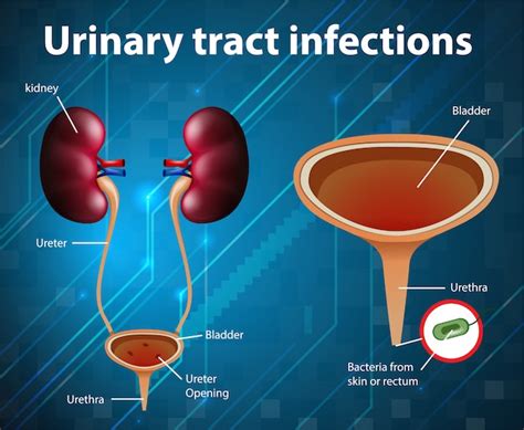 Ilustración Informativa De Infecciones Del Tracto Urinario Vector Gratis