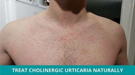 Urticaria Treatment