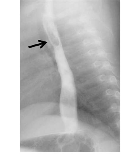 Barium Swallow Revealed The Approximately 3 Cm Mass With Irregular