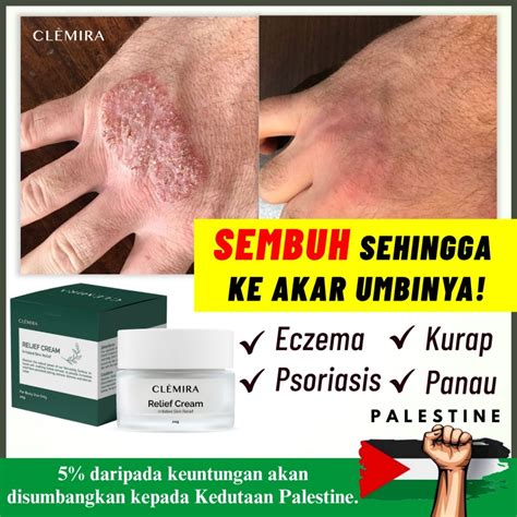 Clemira Relief Cream Ekzema Ubat Gatal Kulit Panau Kurap Ubat Gatal