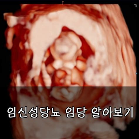 임산부 임당 임신성당뇨에 대해서 알아보기 네이버 블로그