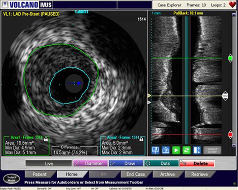 Intravascular Ultrasound Ivus Philips Healthcare