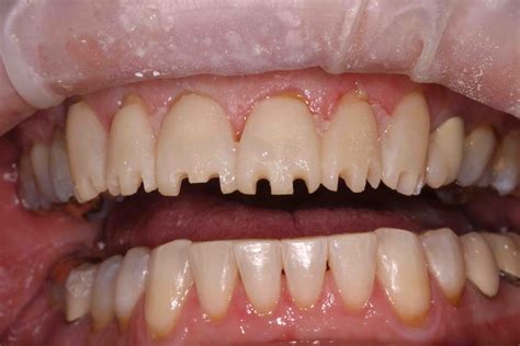 Veneer Preps: Why Do Incisal Reduction? - Lee Ann Brady DMD