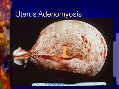 Ppt Leiomyoma An Overview Powerpoint Presentation Free Download