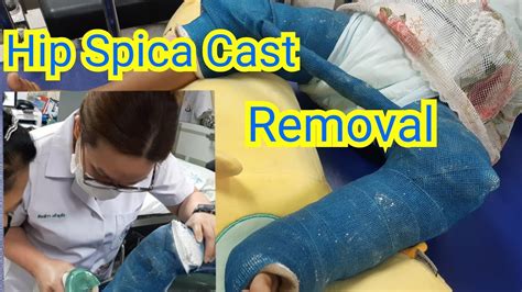 Hip Spica Cast Removal Youtube