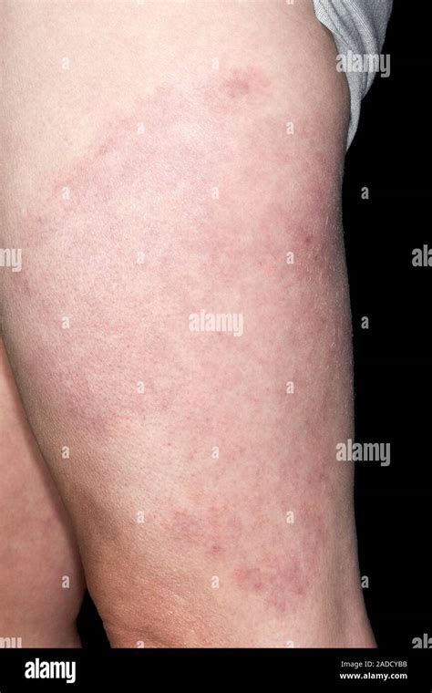 Rash In Lymes Disease In A 59 Year Old Woman Lyme Disease Is Caused