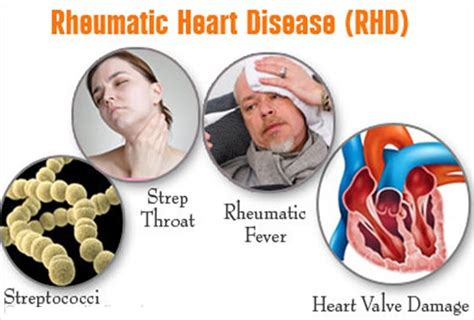 Rheumatic Heart Disease Symptoms And Treatments Faqs