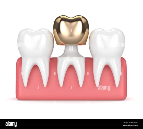 D Render Of Teeth With Dental Golden Crown Filling In Gums Over White