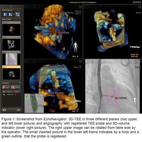 Ismics 3d Echocardiography Angiography Fusion Technology For Complex