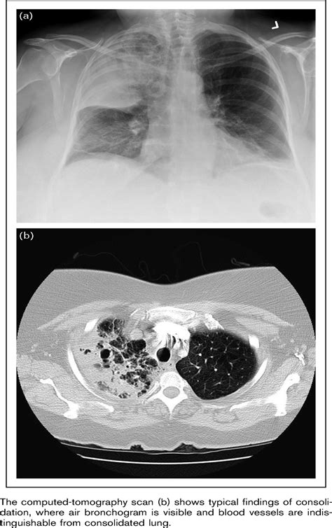 Current Opinion in Pulmonary Medicine