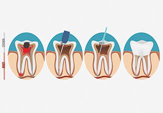 Root Canal Crown Fell Off