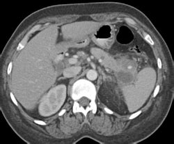 Pseudoaneurysm In The Tail Of The Pancreas Near A Pseudocyst Pancreas