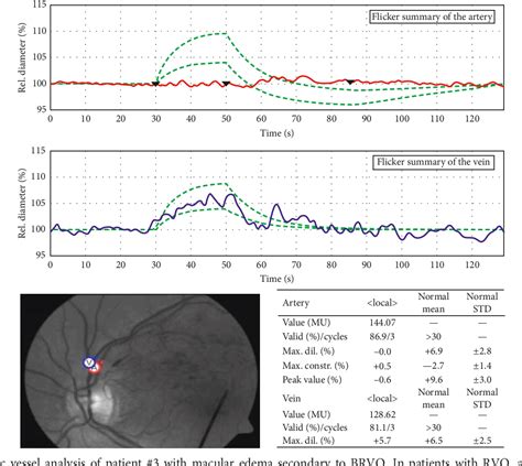 Figure 1 From Impact Of Intravitreal Dexamethasone Implant On Vessel Diameters In Patients With