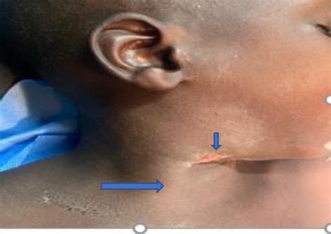 A Healing Wound In The Right Side Of The Zone Ii Region Of The Neck