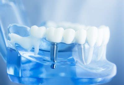 Les Avantages Des Implants Dentaires Prisma Dentistes