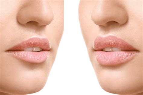 Cuánto dura el relleno de labios con ácido hialurónico y otras