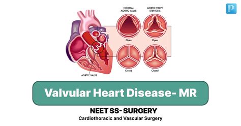 Valvular Heart Disease Mitral Regurgitation