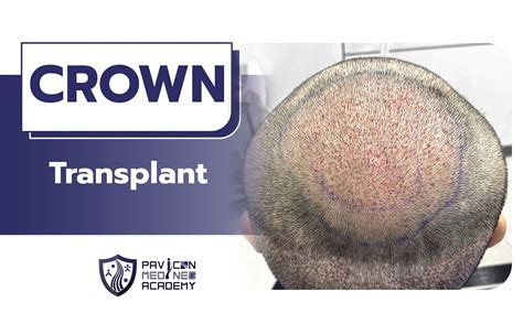 Crown Hair Transplant - Pavicon Mediness Center