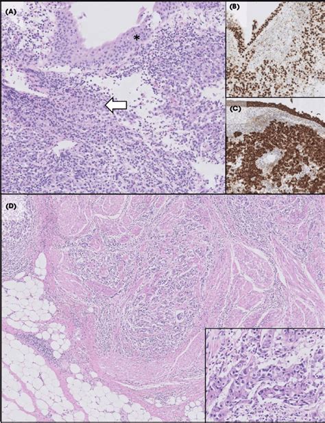 Histopathology Of Biopsy And Cystectomy Specimens A Haematoxyllin