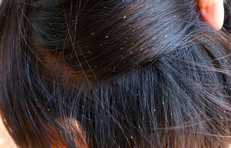 Can Bleaching Hair Kill Lice