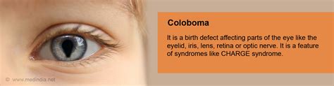 Coloboma Causes Symptoms Diagnosis Treatment And Prevention