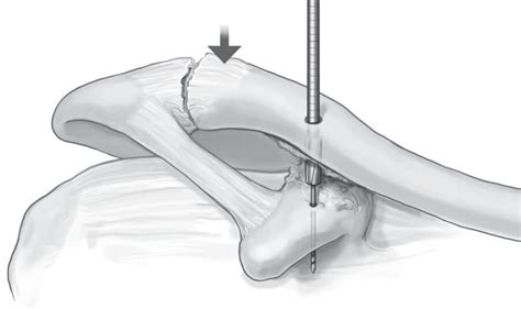 Acromioclavicular Joint Separation Treatment