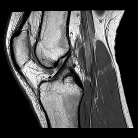 Knee Mri Sagittal Slice Diagram Quizlet The Best Porn Website