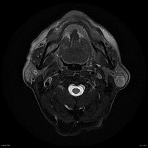 Warthin Tumor Of The Parotid Image Radiopaedia Org