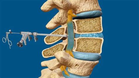 Full Endoscopic Lumbar Canal Stenosis Decompression Asian Spine Hospital