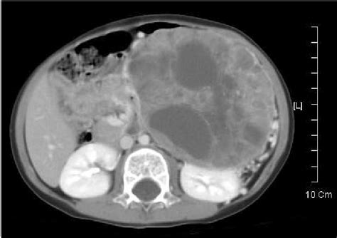 Contrast Enhanced Abdominal Ct Scan Shows Well Defined Solid Mass