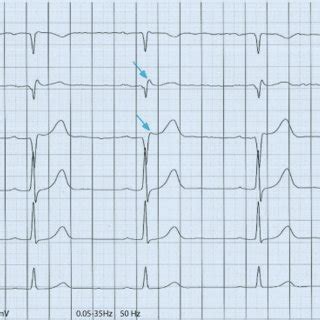 Belastungs EKG Bei Proband Mit Brugada Syndrom A Vor Der Belastung